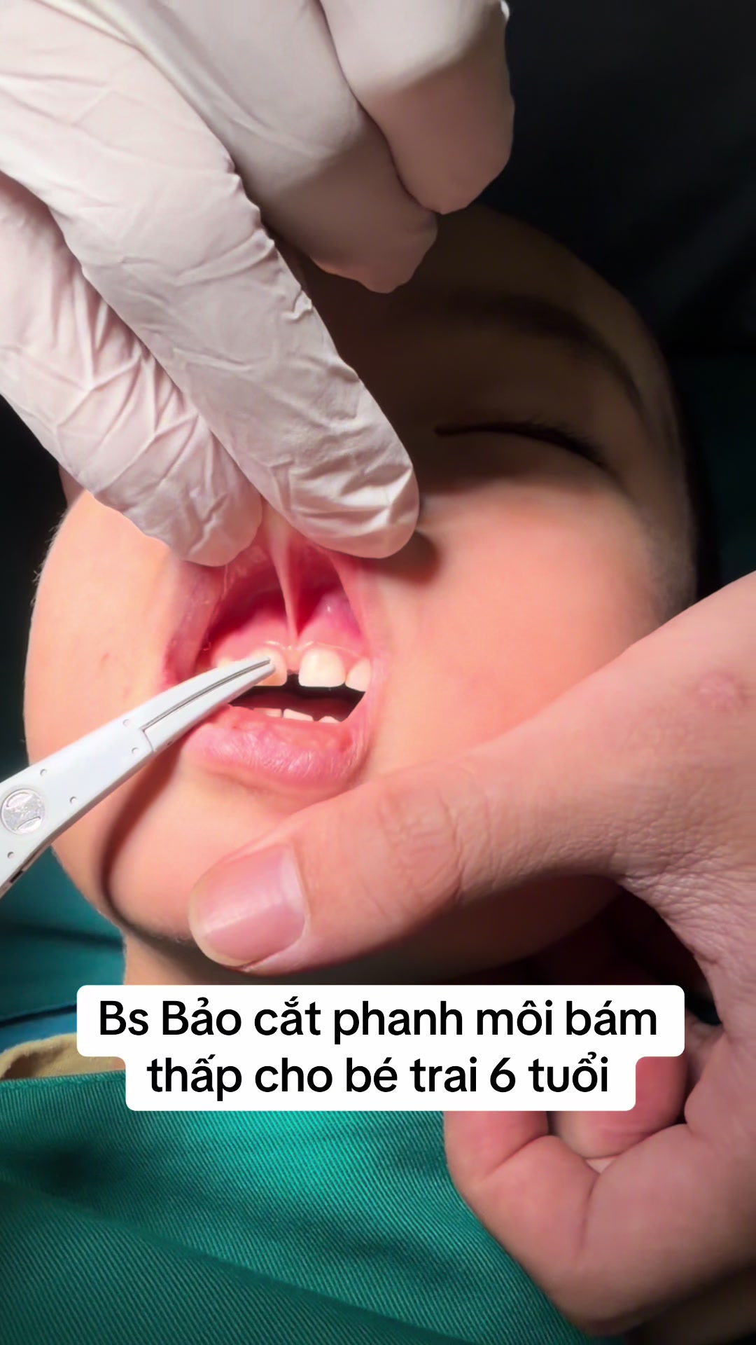 Bs Bảo cắt phanh môi bám thấp cho bé trai 6 tuổi #phanh_môi_bám_thấp #phanh_môi_trên 