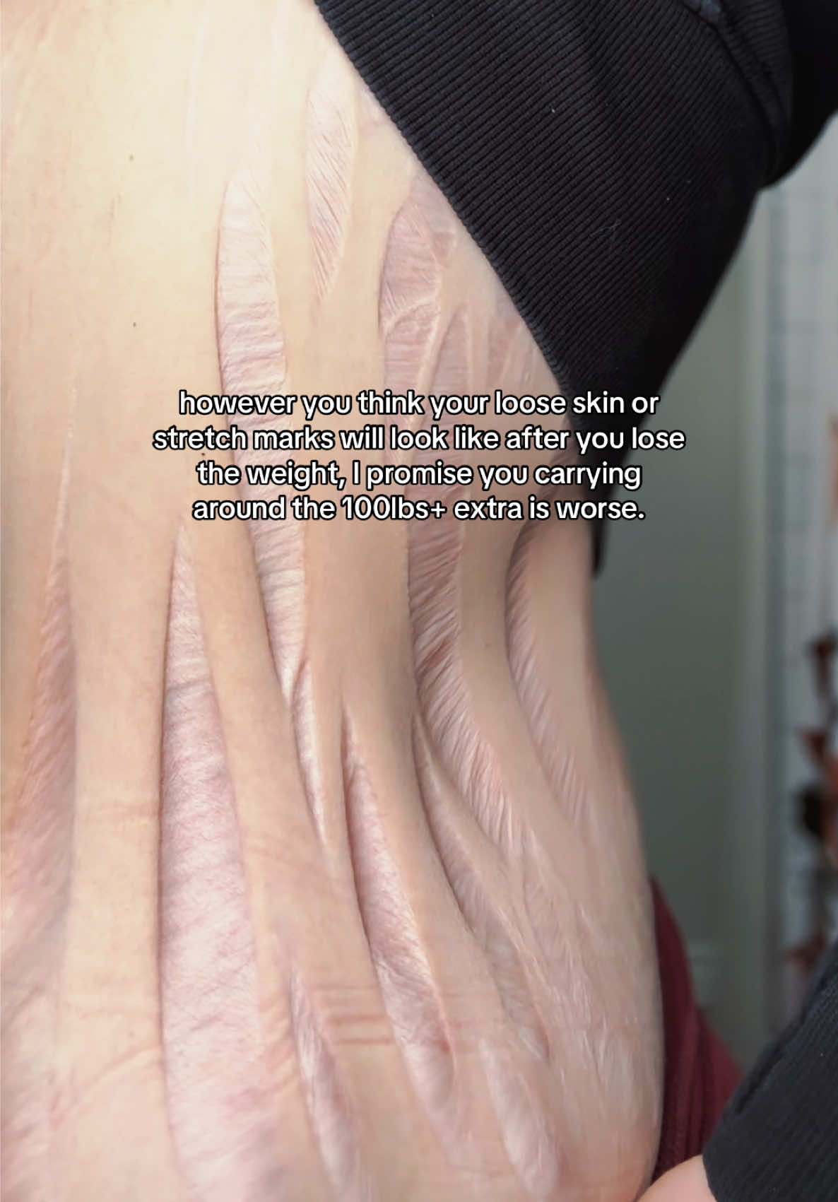 However bad you think your loose skin or stretch marks will be after you lose the weight, I promise carrying around the extra 100lbs+ is worse. I have loose skin and I have stretch marks, I lost an extreme amount of weight and my body looks nothing like someone who’s never been overweight. But I still wouldn’t go back… not for a single day. The body I was living in before was stopping me from doing literally everything and no amount of “smooth skin” would have been worth staying there. The loose skin doesn’t stop me from living my life and the stretch marks don’t stop me from living my life. But for me at 330lbs, I physically couldn’t do the things I wanted to be doing. I was out of breath, I was hiding in photos, I was saying no to things I actually wanted to say yes to. If the fear of loose skin is what’s keeping you stuck I just want you to know that staying the same would have been so much worse for me than worrying about what my body might look like on the other side.   Your body is going to change in ways you can’t prepare for and some of it will be hard. But every single version of me after losing the weight has felt more like me than the one I was stuck in before. Don’t let the fear of stretch marks and loose skin keep you from meeting the version of you that’s waiting on the other side🫶🏻