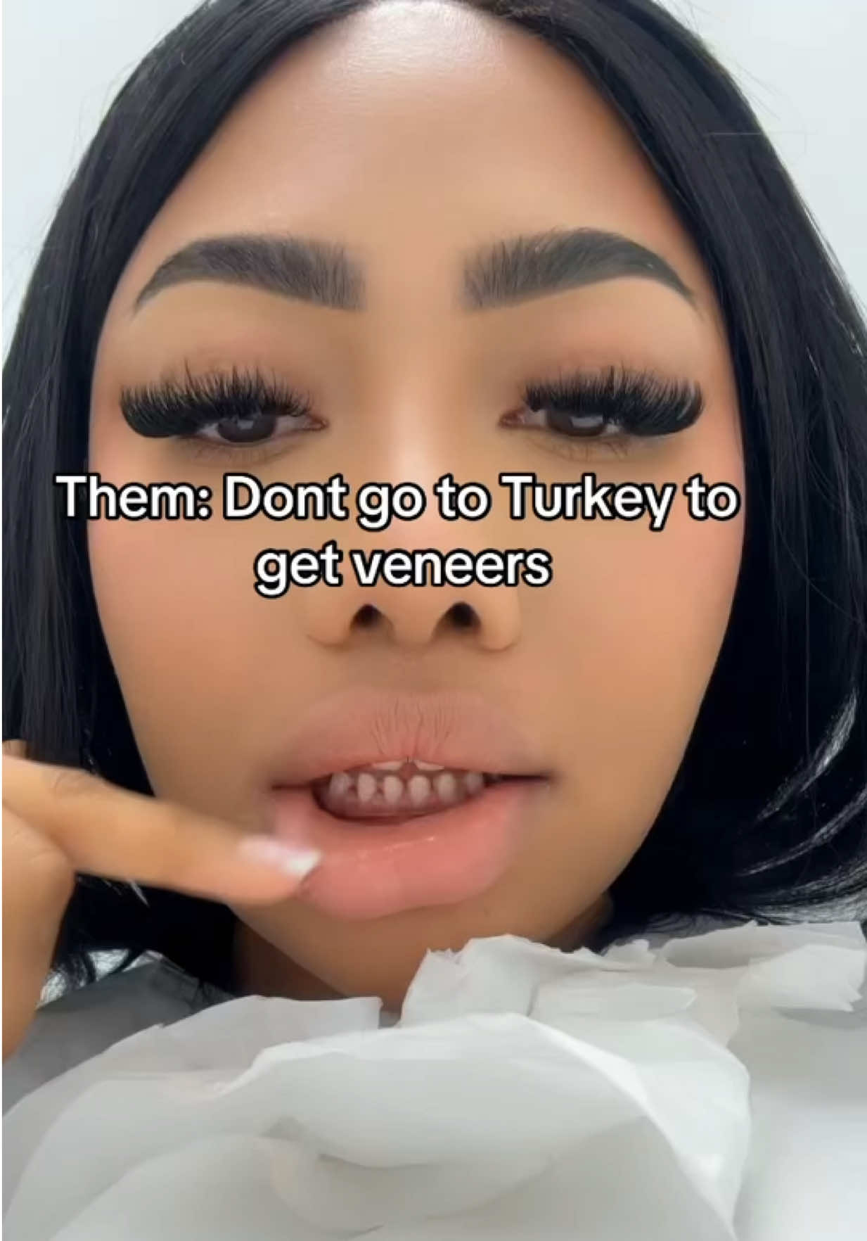 Get veneers in turkey tiktok said 🦷 #veneers #turkeyteeth #turkeyveneers #fyp #somalitiktok 